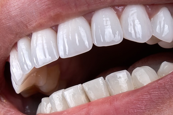 How Dental Bonding Is Used For Cosmetic And Restorative Dentistry