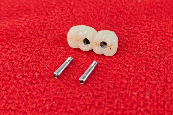 How Long Does An Implant Crown Restoration Last?