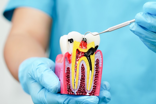 Can Multiple Teeth Need A Root Canal?